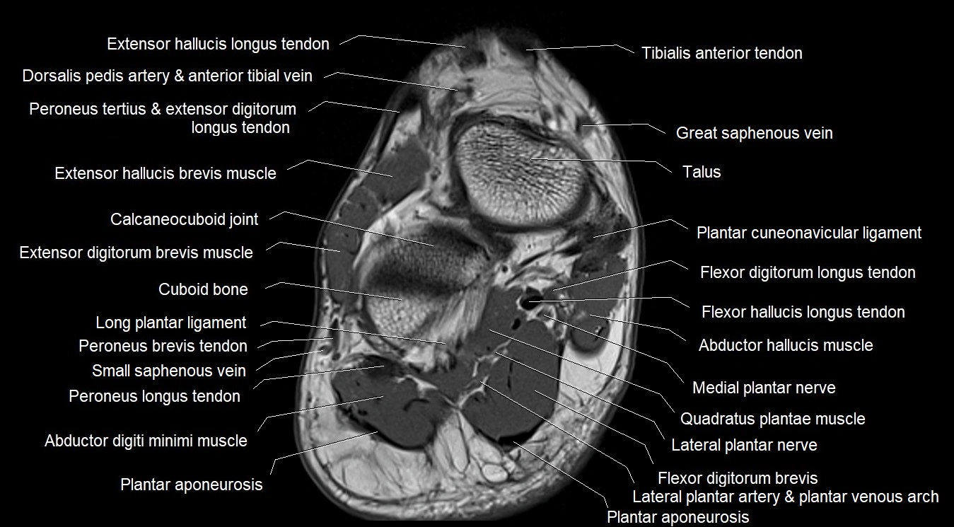 MRI 3T foot axial cross sectional anatomy image 2.webp